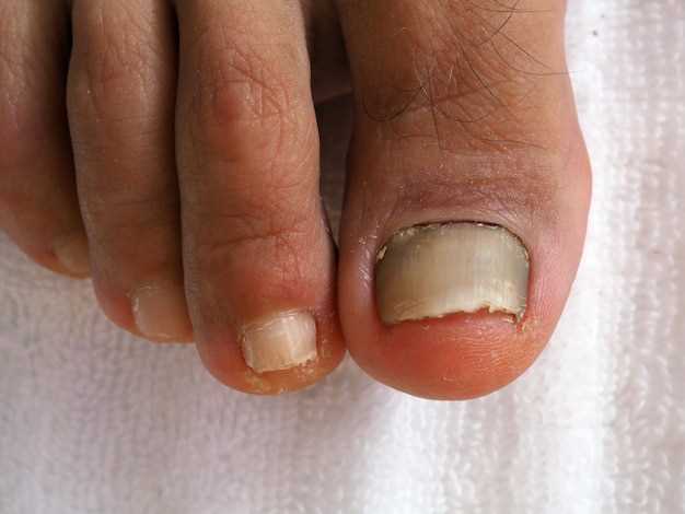 Симптомы и лечение микозов ногтей