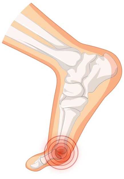 Косточка на стороне стопы: причины, симптомы и лечение